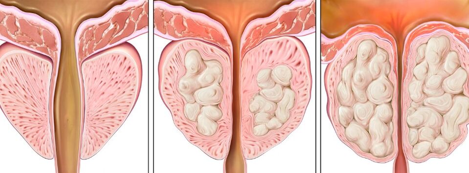 Stages of prostatitis